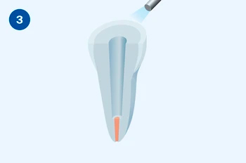 Применение Люксакор Z Дуал Смартмикс - этап 3